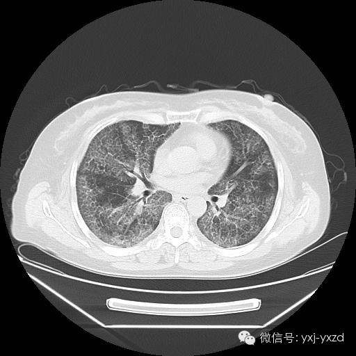 【病例】肺泡蛋白沉积症1例CT影像表现 【病例】肺泡蛋白沉积症1例CT影像表现
