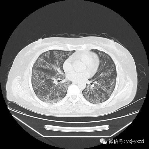 【病例】肺泡蛋白沉积症1例CT影像表现 【病例】肺泡蛋白沉积症1例CT影像表现