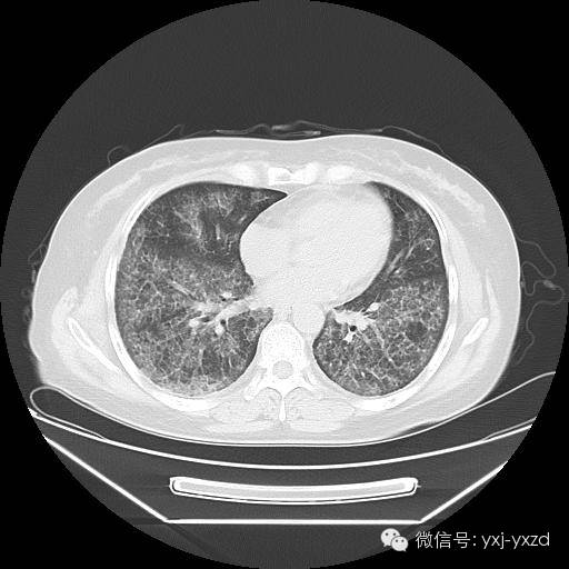 【病例】肺泡蛋白沉积症1例CT影像表现 【病例】肺泡蛋白沉积症1例CT影像表现