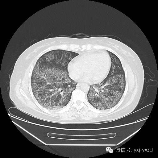 【病例】肺泡蛋白沉积症1例CT影像表现 【病例】肺泡蛋白沉积症1例CT影像表现