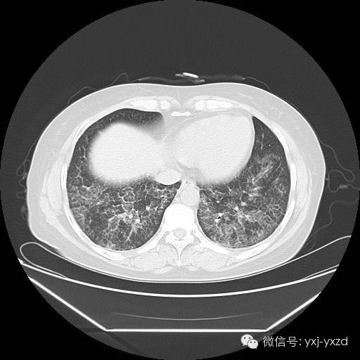 【病例】肺泡蛋白沉积症1例CT影像表现 【病例】肺泡蛋白沉积症1例CT影像表现
