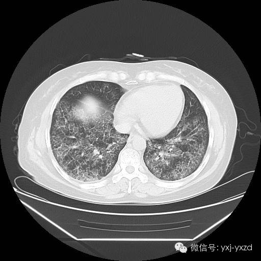 【病例】肺泡蛋白沉积症1例CT影像表现 【病例】肺泡蛋白沉积症1例CT影像表现
