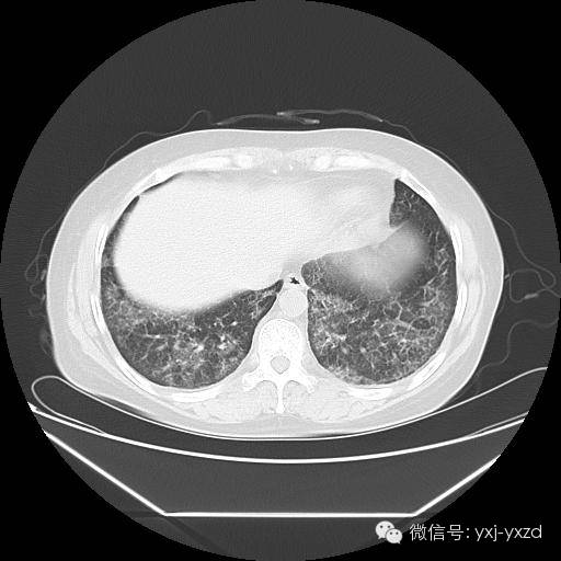 【病例】肺泡蛋白沉积症1例CT影像表现 【病例】肺泡蛋白沉积症1例CT影像表现