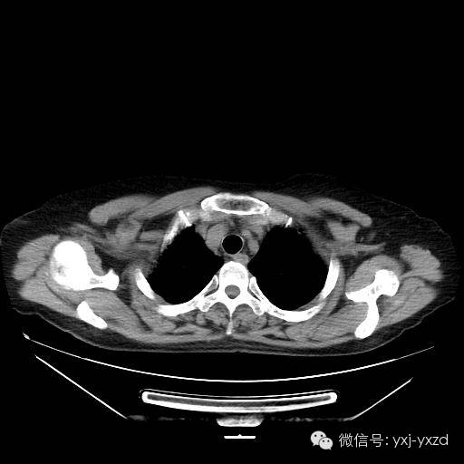 【病例】肺泡蛋白沉积症1例CT影像表现 【病例】肺泡蛋白沉积症1例CT影像表现