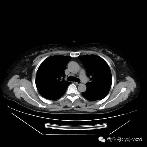 【病例】肺泡蛋白沉积症1例CT影像表现 【病例】肺泡蛋白沉积症1例CT影像表现