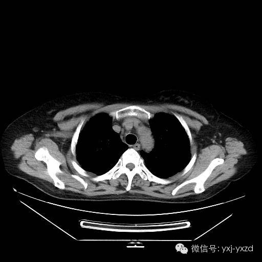 【病例】肺泡蛋白沉积症1例CT影像表现 【病例】肺泡蛋白沉积症1例CT影像表现