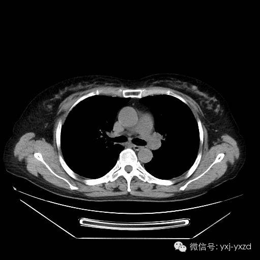 【病例】肺泡蛋白沉积症1例CT影像表现 【病例】肺泡蛋白沉积症1例CT影像表现