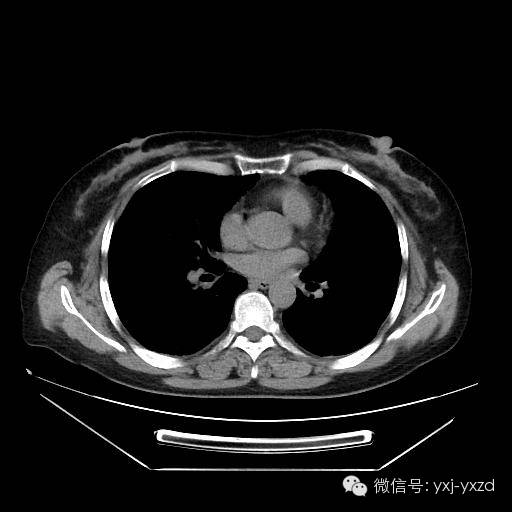 【病例】肺泡蛋白沉积症1例CT影像表现 【病例】肺泡蛋白沉积症1例CT影像表现