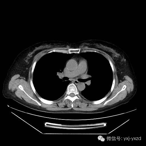 【病例】肺泡蛋白沉积症1例CT影像表现 【病例】肺泡蛋白沉积症1例CT影像表现