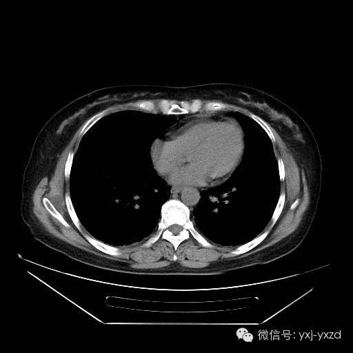 【病例】肺泡蛋白沉积症1例CT影像表现 【病例】肺泡蛋白沉积症1例CT影像表现