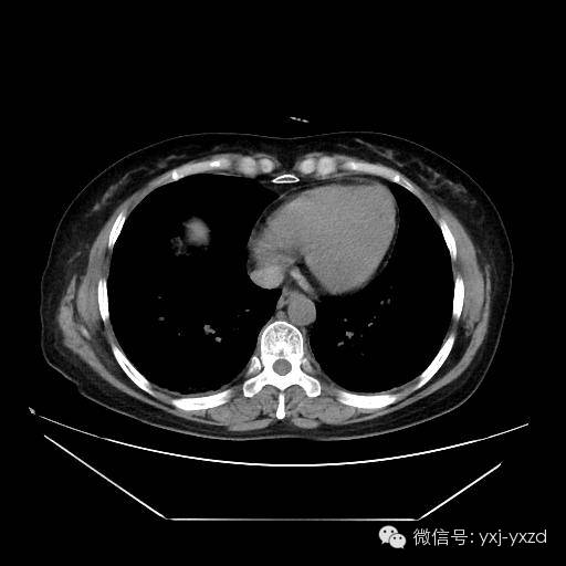 【病例】肺泡蛋白沉积症1例CT影像表现 【病例】肺泡蛋白沉积症1例CT影像表现
