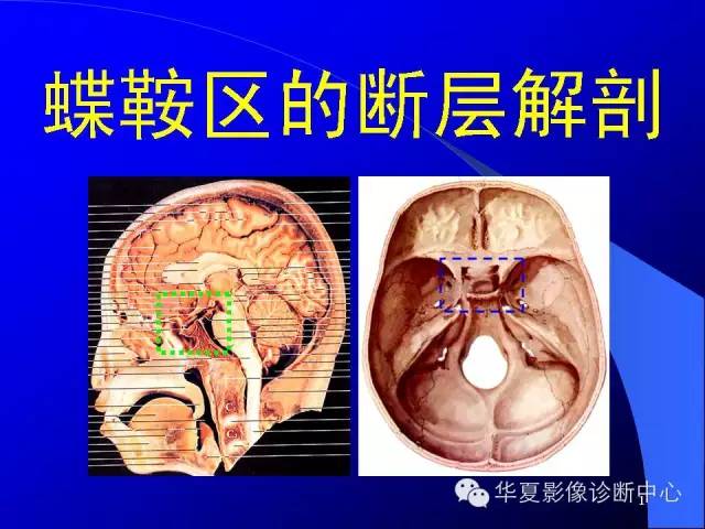 蝶鞍-脑室-脑池（高清+详细标注）