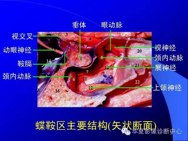 蝶鞍-脑室-脑池（高清+详细标注）
