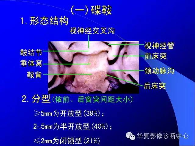 蝶鞍-脑室-脑池（高清+详细标注）