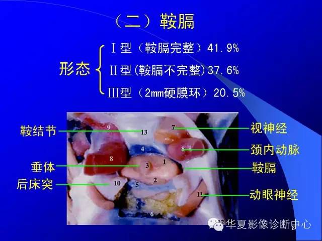 蝶鞍-脑室-脑池（高清+详细标注）