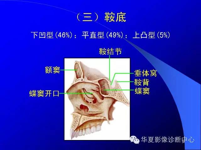 蝶鞍-脑室-脑池（高清+详细标注）