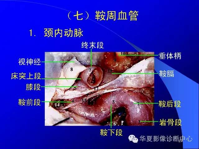 蝶鞍-脑室-脑池（高清+详细标注）