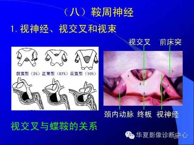 蝶鞍-脑室-脑池（高清+详细标注）