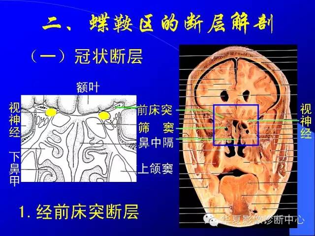 蝶鞍-脑室-脑池（高清+详细标注）