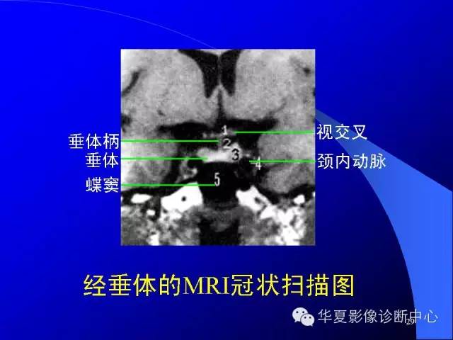 蝶鞍-脑室-脑池（高清+详细标注）