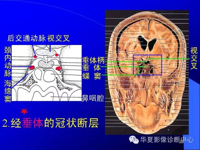 蝶鞍-脑室-脑池（高清+详细标注）