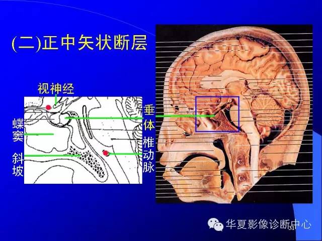 蝶鞍-脑室-脑池（高清+详细标注）