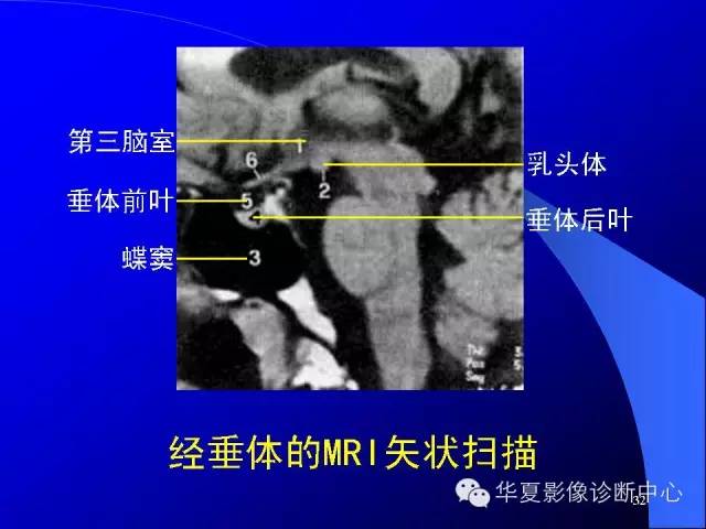 蝶鞍-脑室-脑池（高清+详细标注）