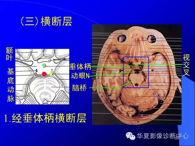 蝶鞍-脑室-脑池（高清+详细标注）
