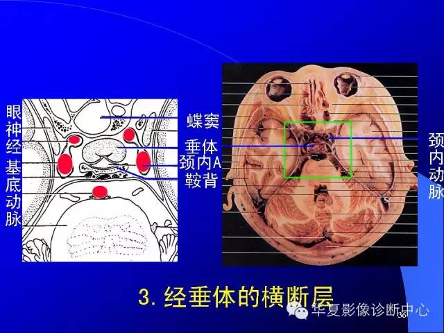 蝶鞍-脑室-脑池（高清+详细标注）