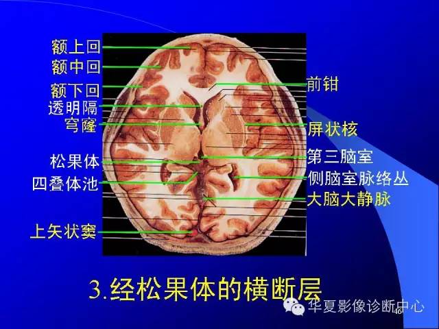 蝶鞍-脑室-脑池（高清+详细标注）