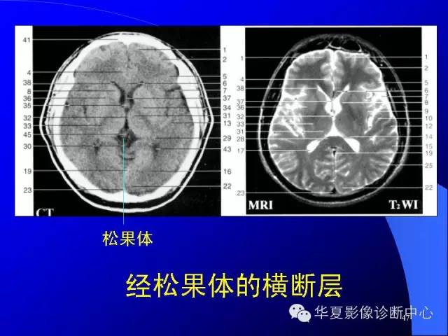 蝶鞍-脑室-脑池（高清+详细标注）