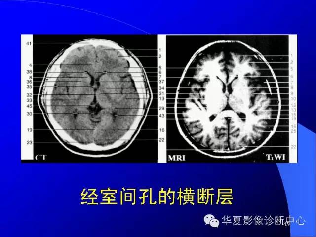 蝶鞍-脑室-脑池（高清+详细标注）