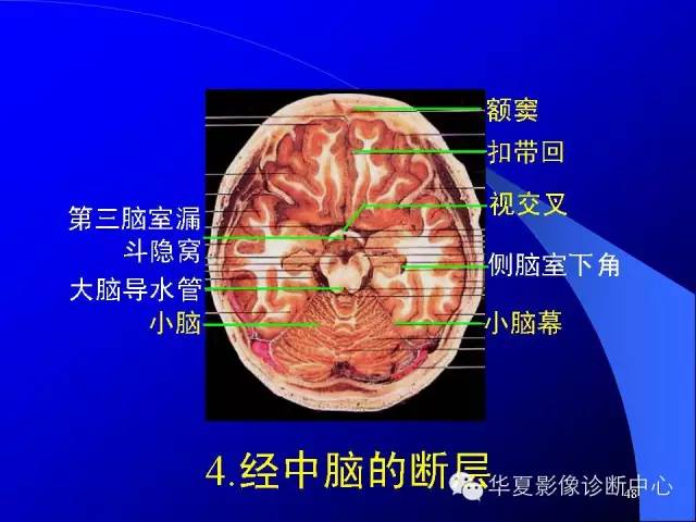 蝶鞍-脑室-脑池（高清+详细标注）
