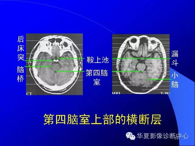 蝶鞍-脑室-脑池（高清+详细标注）