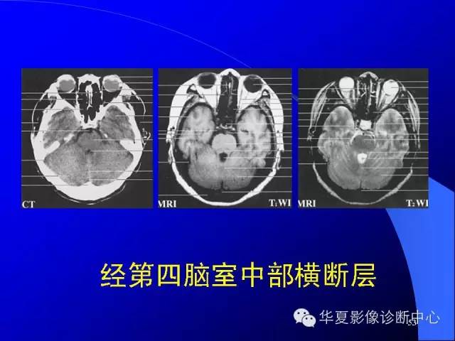 蝶鞍-脑室-脑池（高清+详细标注）