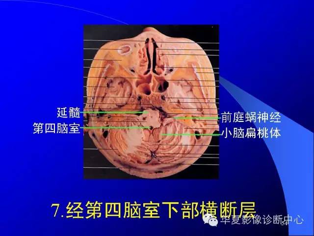 蝶鞍-脑室-脑池（高清+详细标注）
