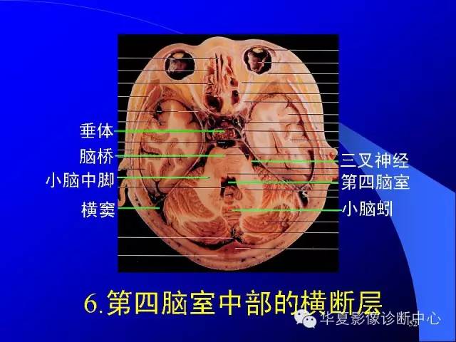 蝶鞍-脑室-脑池（高清+详细标注）