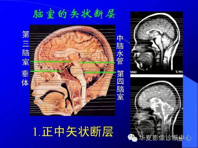 蝶鞍-脑室-脑池（高清+详细标注）