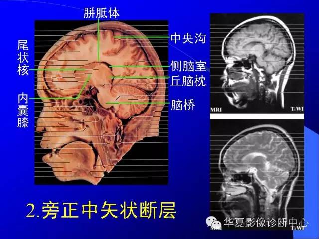 蝶鞍-脑室-脑池（高清+详细标注）
