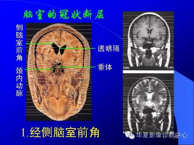 蝶鞍-脑室-脑池（高清+详细标注）