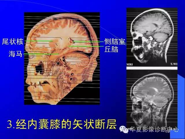 蝶鞍-脑室-脑池（高清+详细标注）