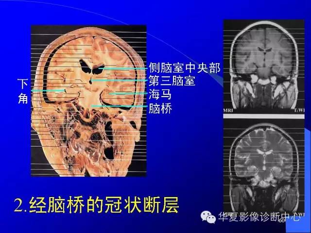 蝶鞍-脑室-脑池（高清+详细标注）