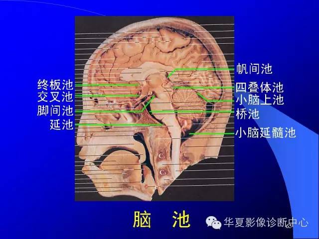 蝶鞍-脑室-脑池（高清+详细标注）