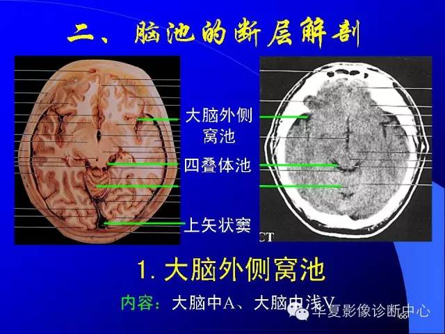 蝶鞍-脑室-脑池（高清+详细标注）