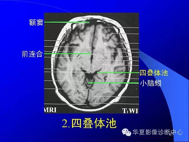 蝶鞍-脑室-脑池（高清+详细标注）
