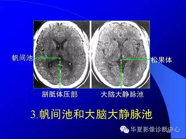 蝶鞍-脑室-脑池（高清+详细标注）