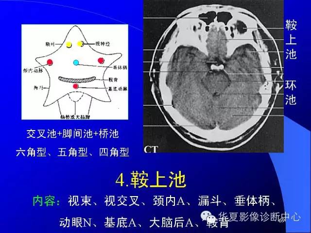 蝶鞍-脑室-脑池（高清+详细标注）