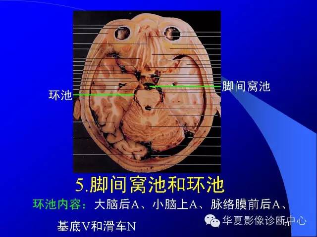 蝶鞍-脑室-脑池（高清+详细标注）