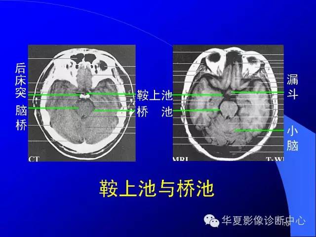蝶鞍-脑室-脑池（高清+详细标注）