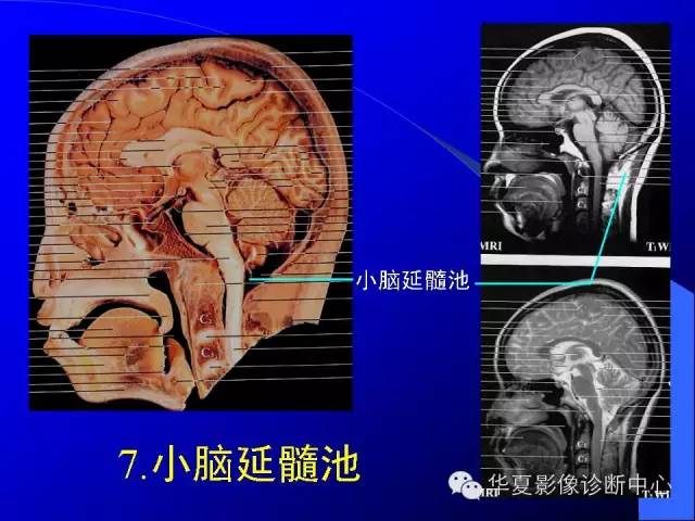 蝶鞍-脑室-脑池（高清+详细标注）